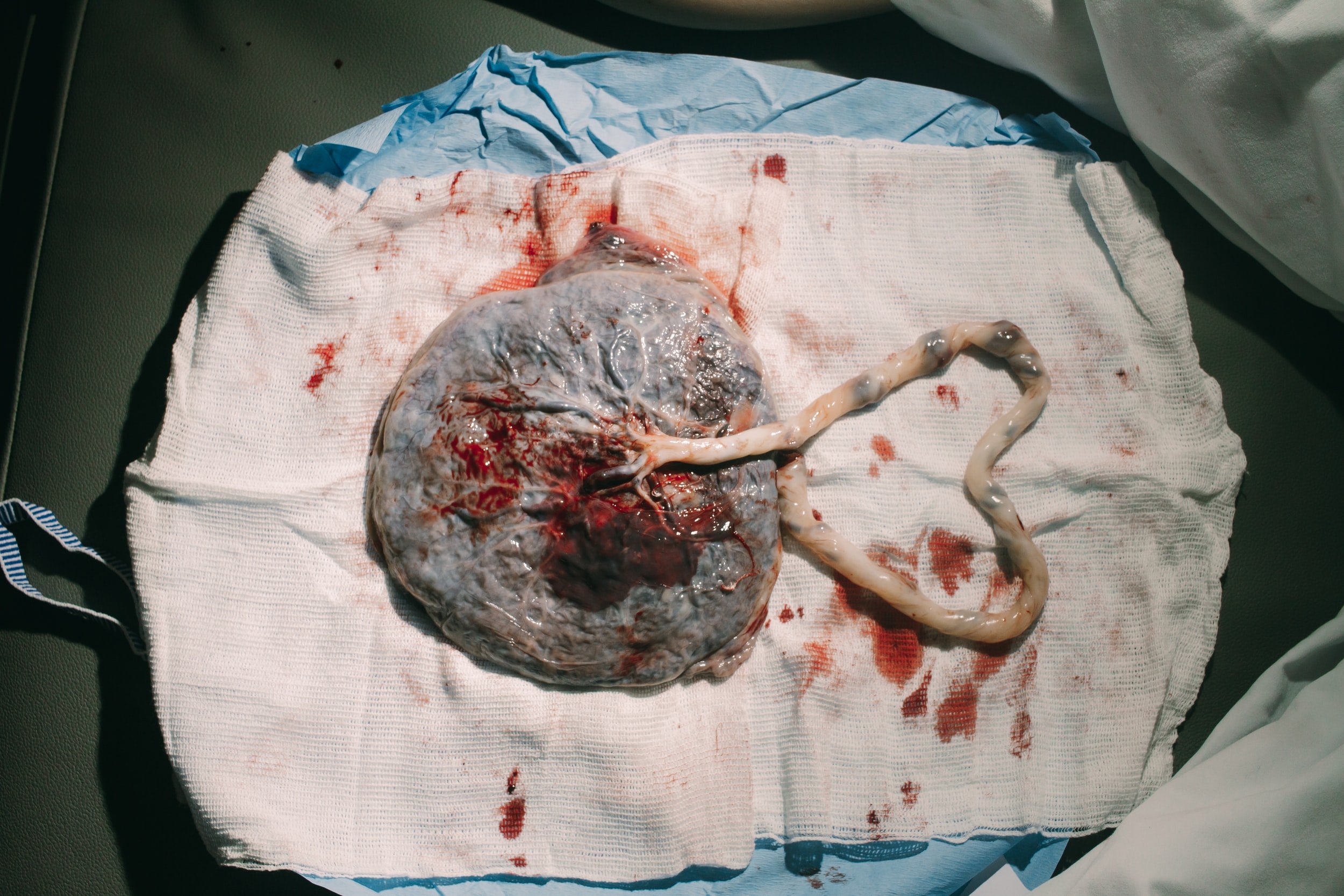 Placenta tree of life pattern — the branching vessels resemble a tree